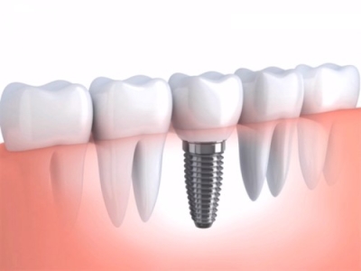 CapacitaciÃ³n en OdontologÃ­a e Implantes